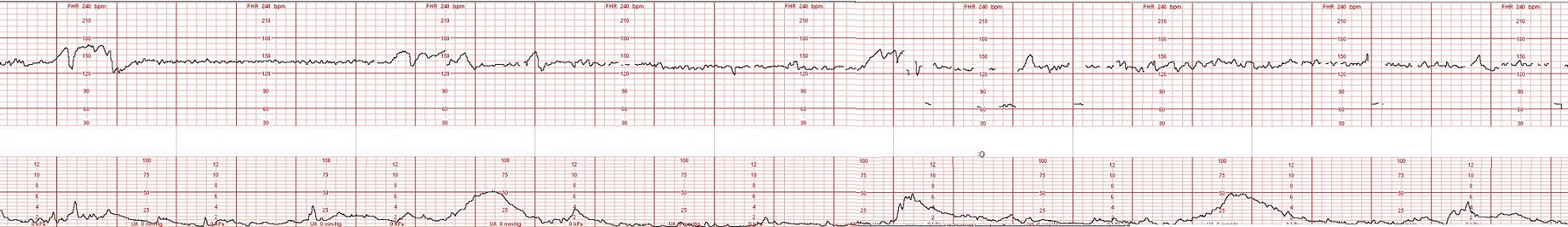 fetal heart tone monitor