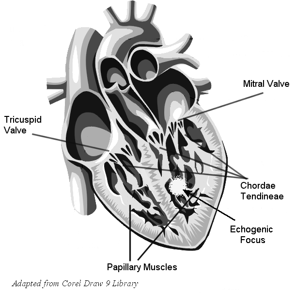 EIFEchogenic intracardiac focus