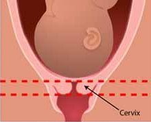 Short cervix
