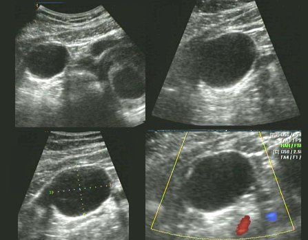 ADNEXAL MASSES IN PREGNANCY: A TWO- CENTER EXPERIENCE | The Medical-Surgical Journal