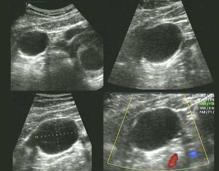 Ovarian cancer during pregnancy