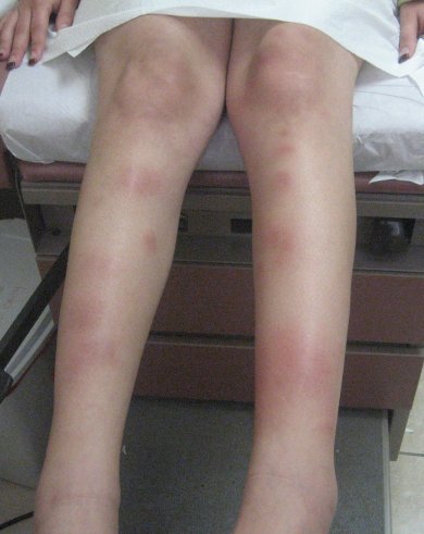 thrombophlebitis migrans