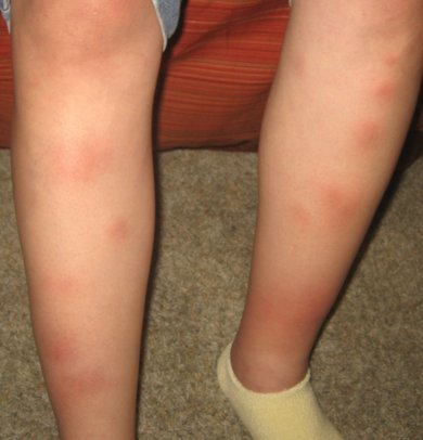 What Is a Diabetic Rash? (with pictures) - wiseGEEK