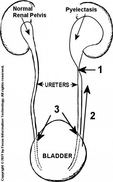 Fetal pyelectasis