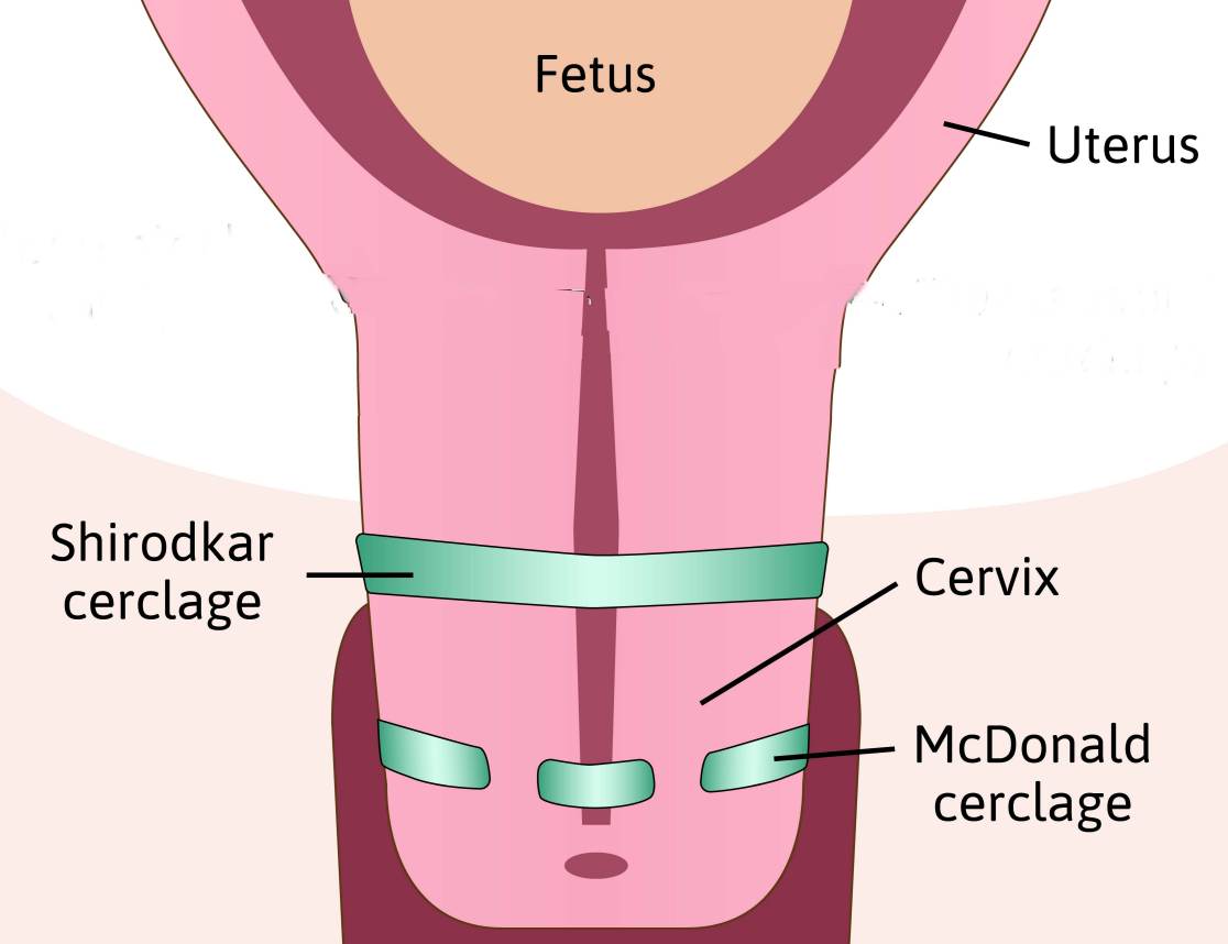 Cerclages