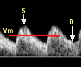Umbilical artery Doppler waveform (saw-tooth appearance)