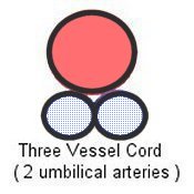 3 vessel umbilical cord