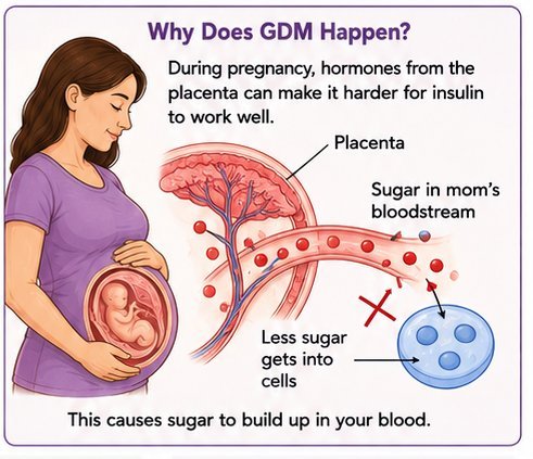 Patient-friendly illustration of pregnancy, placenta, and gestational diabetes.